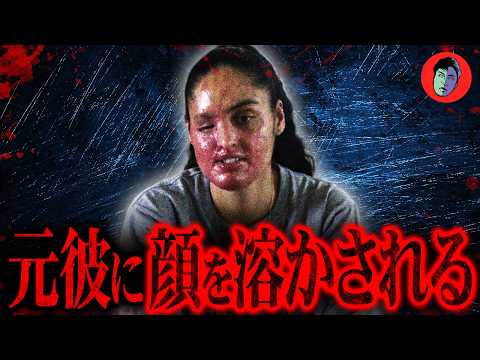 元彼に硫酸を浴びせられる…発端は「真剣交際じゃない」の一言 サムネイル