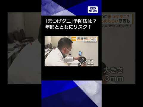 【ニュース】目のゴロゴロ「まつげダニ」？結膜炎＆ものもらい原因も　加齢とともに有病率が上昇 shorts サムネイル